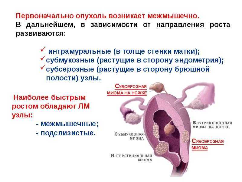 Интерстициальная миома матки