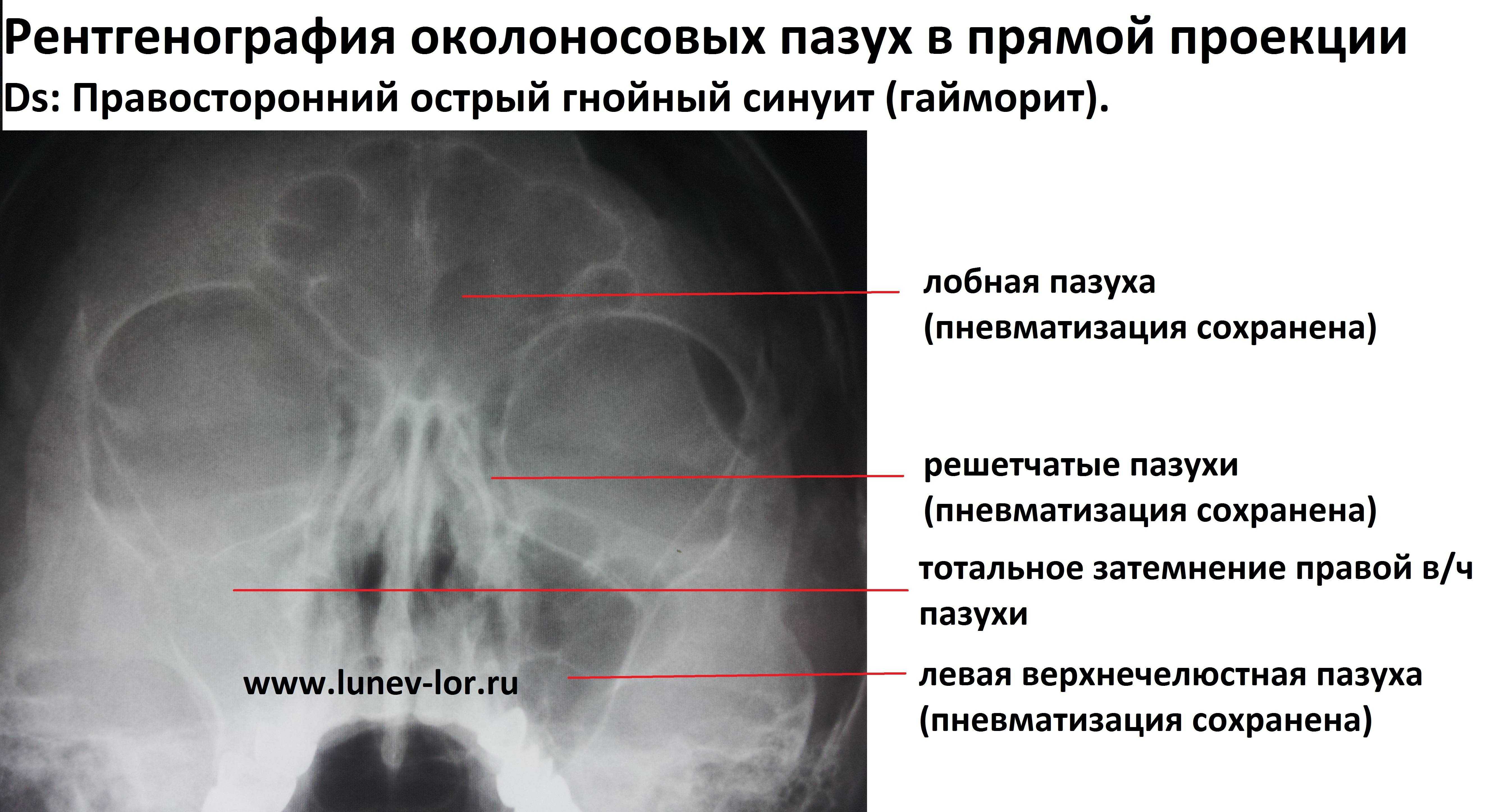 Что такое пневматизация пазух носа сохранена: причины и последствия