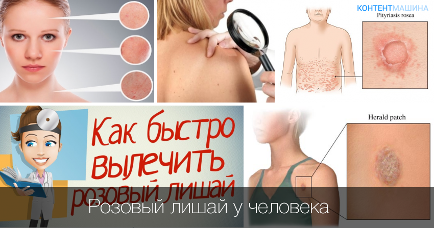 Розовый лишай: особенности, диагностика и лечение