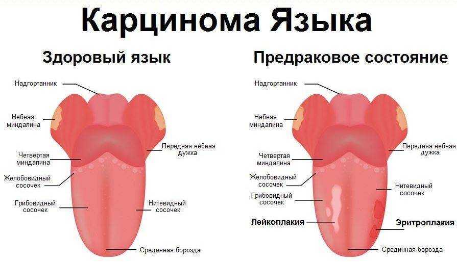 Типун на языке (глоссит): что это такое?