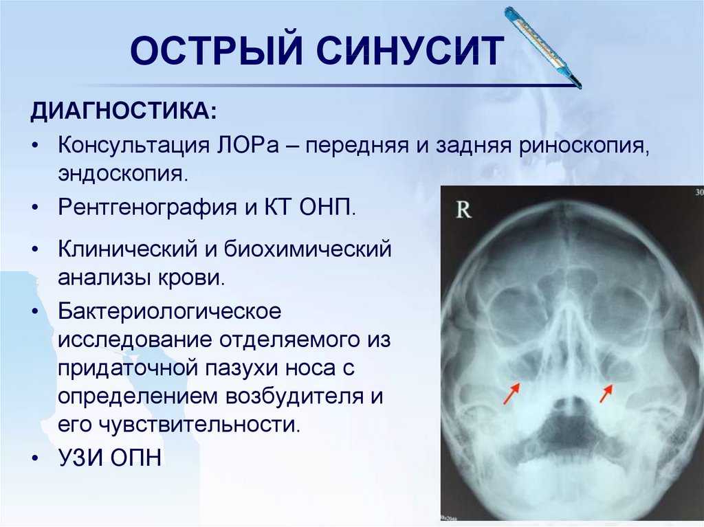 Гайморит - симптомы, причины, лечение и профилактика у взрослых и детей