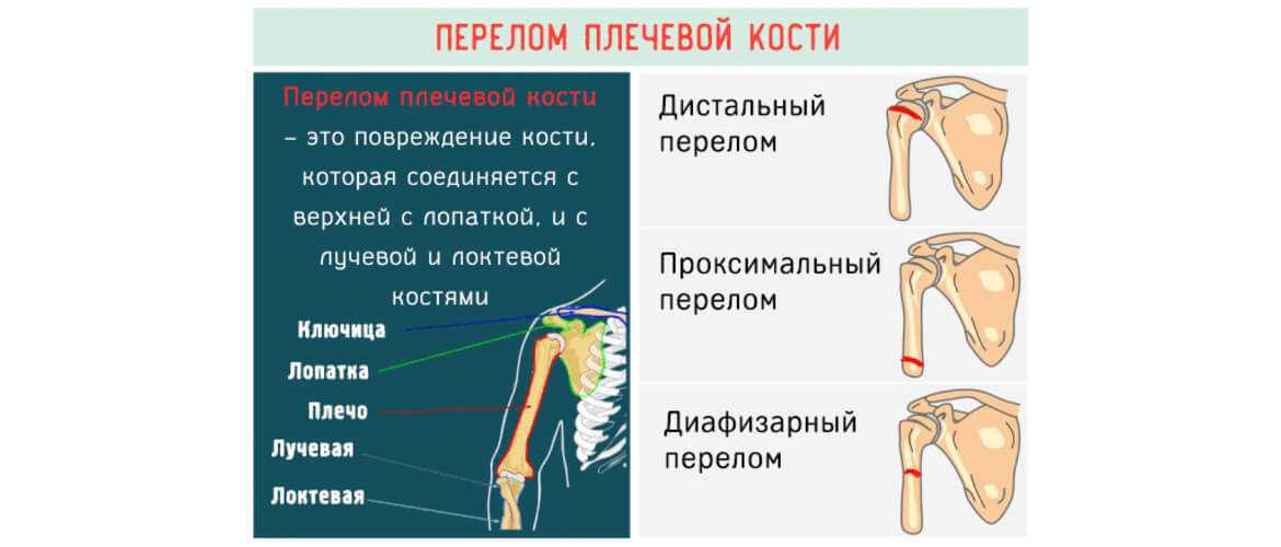 Реабилитация (лфк) после переломов плечевого сустава. врач на дому - рентген на дому в с-петербурге в день вызова