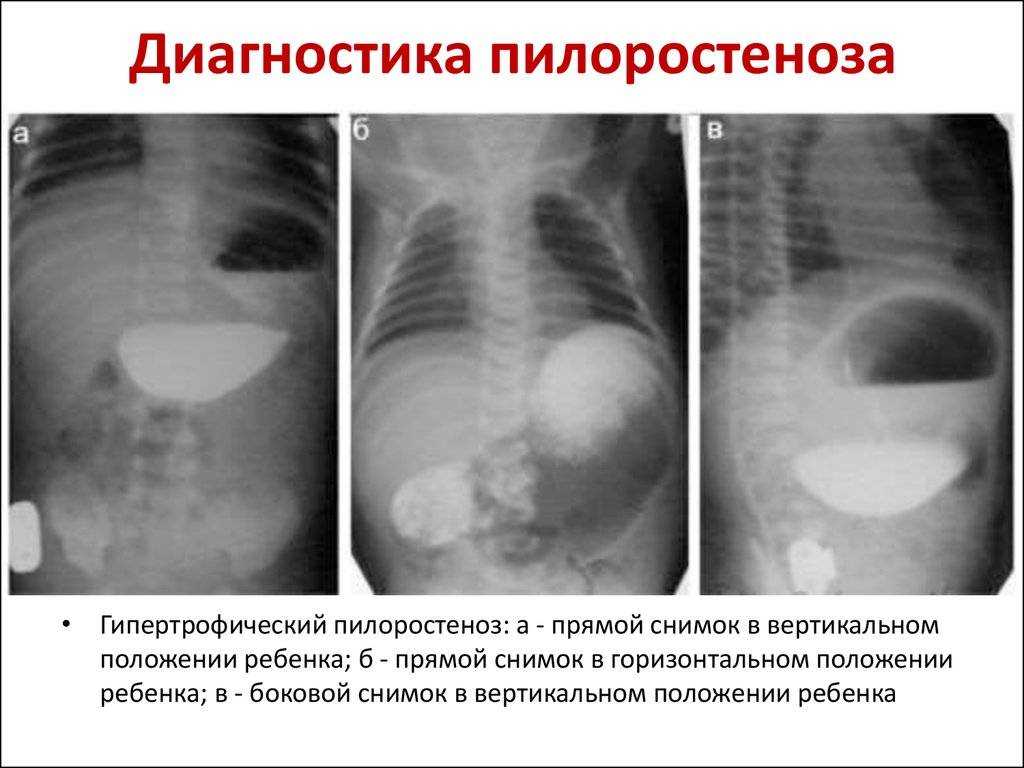Пилороспазм у новорождённых: диагностика, симптоматика и лечение