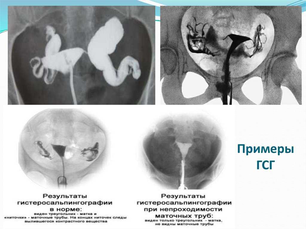 Беременность с одной трубой: что нужно знать | лейб медик