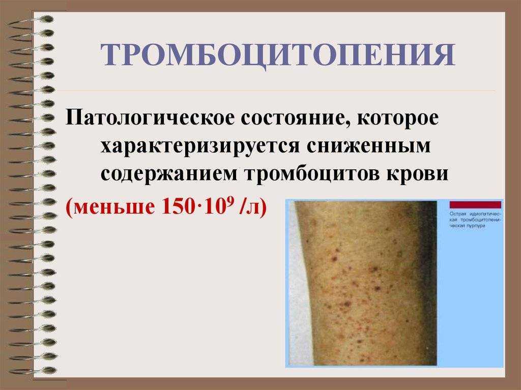 Геморрагический васкулит у детей: причины, симптомы и лечение