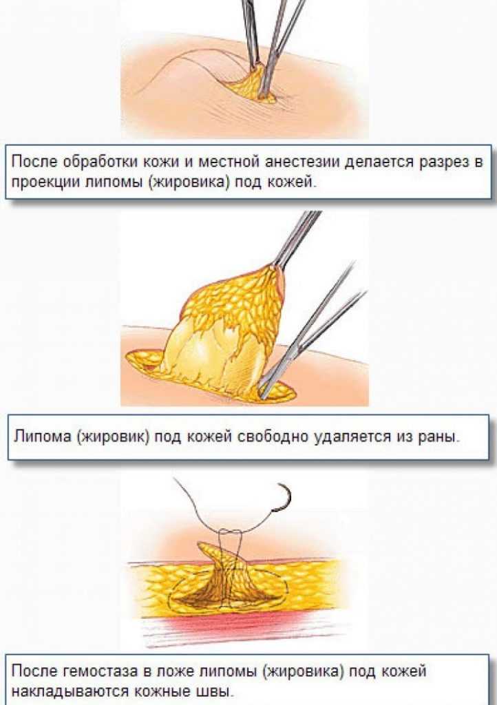 Липома (жировик, липобластома, жировая опухоль)