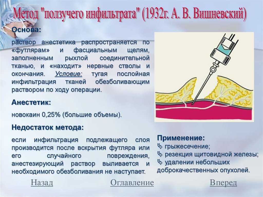 Метод инфильтрационной анестезии
