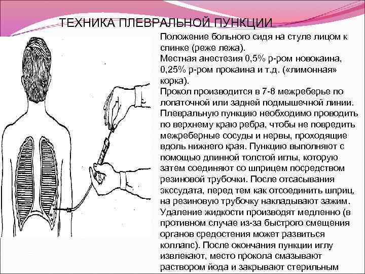 Пункция плевральной полости - техника проведения процедуры | pro-zdorov.ru