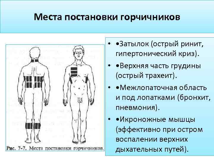 Горчичники при кашле: как ставить взрослым и детям | омнитус®