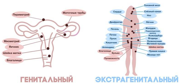 Все про эндометриоз