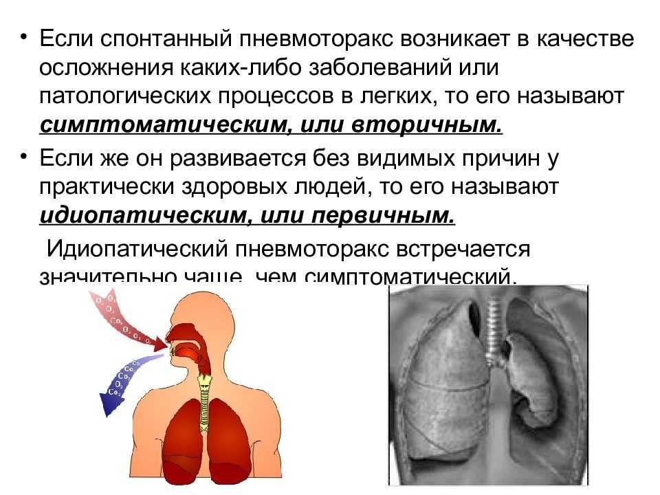 Пневмоторакс легких: что это такое, симптомы, причины, лечение и прогноз