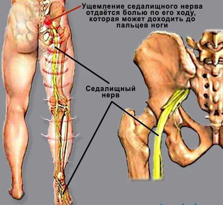 Седалищный нерв: возможны ли повреждения при уколах