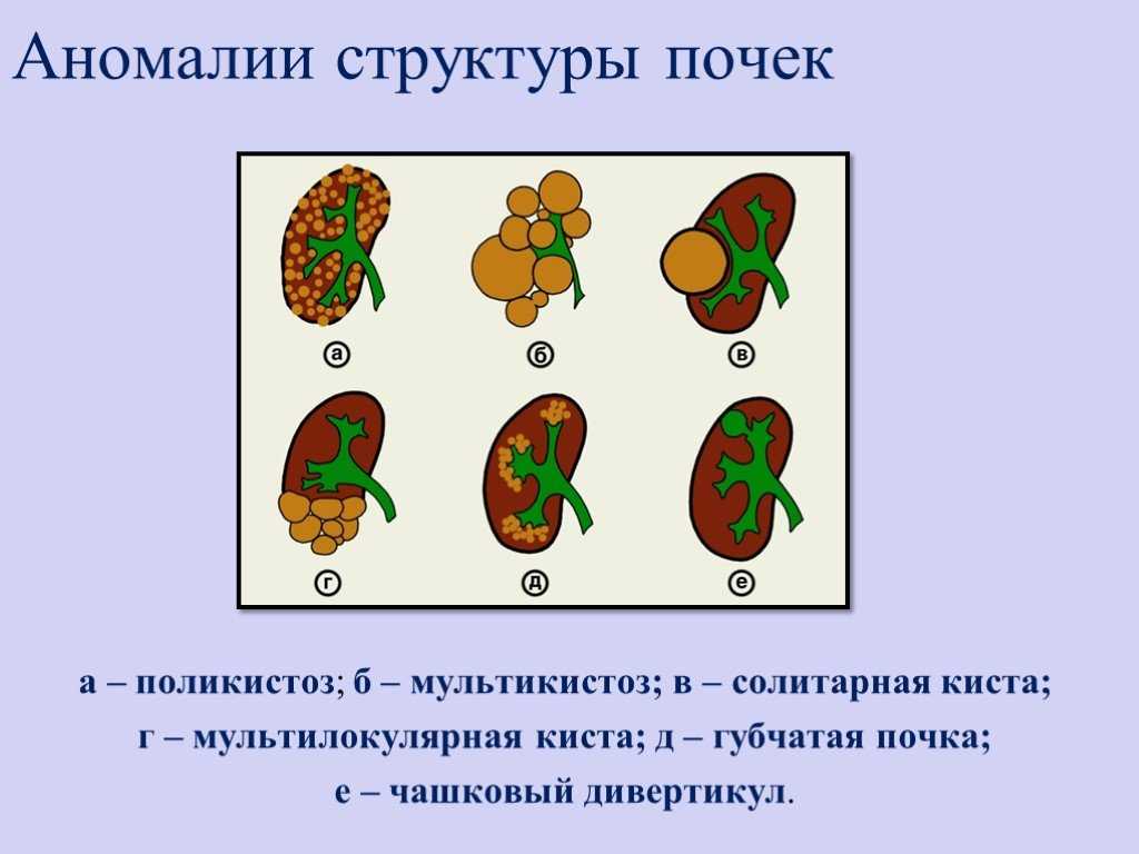 Врожденные аномалии почек, причины