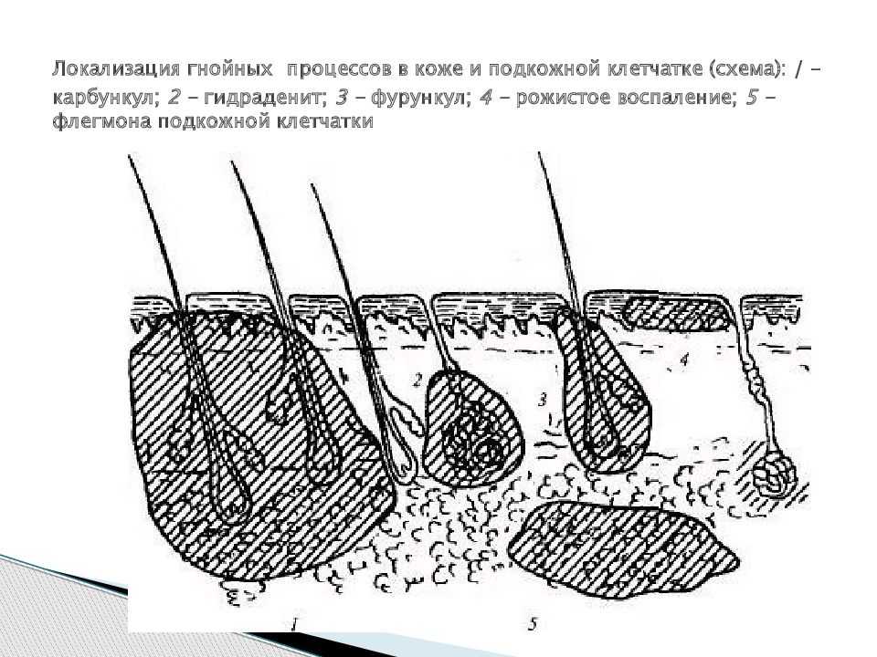 Фурункул — детская челюстно-лицевая хирургия