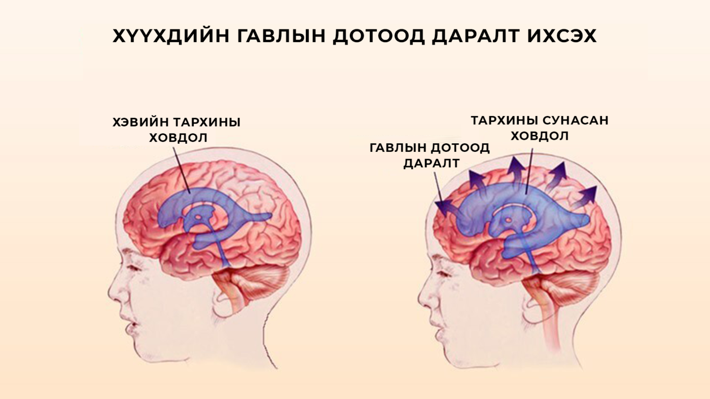 Гипертензионный синдром  Гипертензионный синдром  Гипертензионный синдром — заболевание, в результате которого могут развиться осложнения или наступить