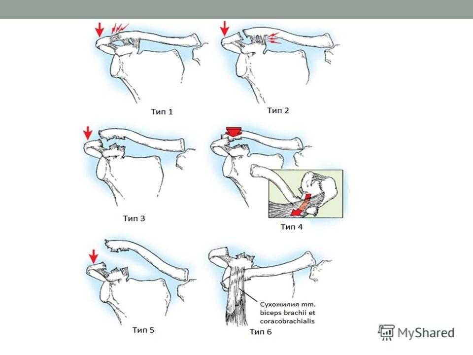 Разрыв акромиально-ключичного сочленения
