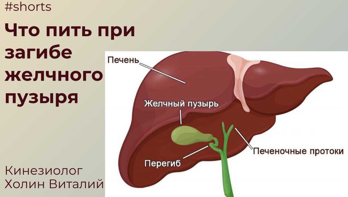 Перегиб и перетяжка желчного пузыря