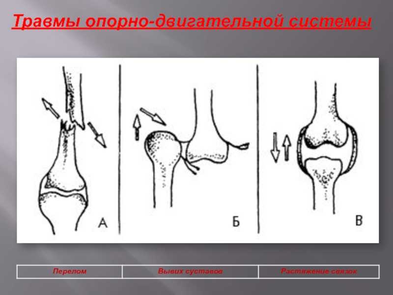 Как отличить ушиб, вывих и перелом: отличительная характеристика симптомов