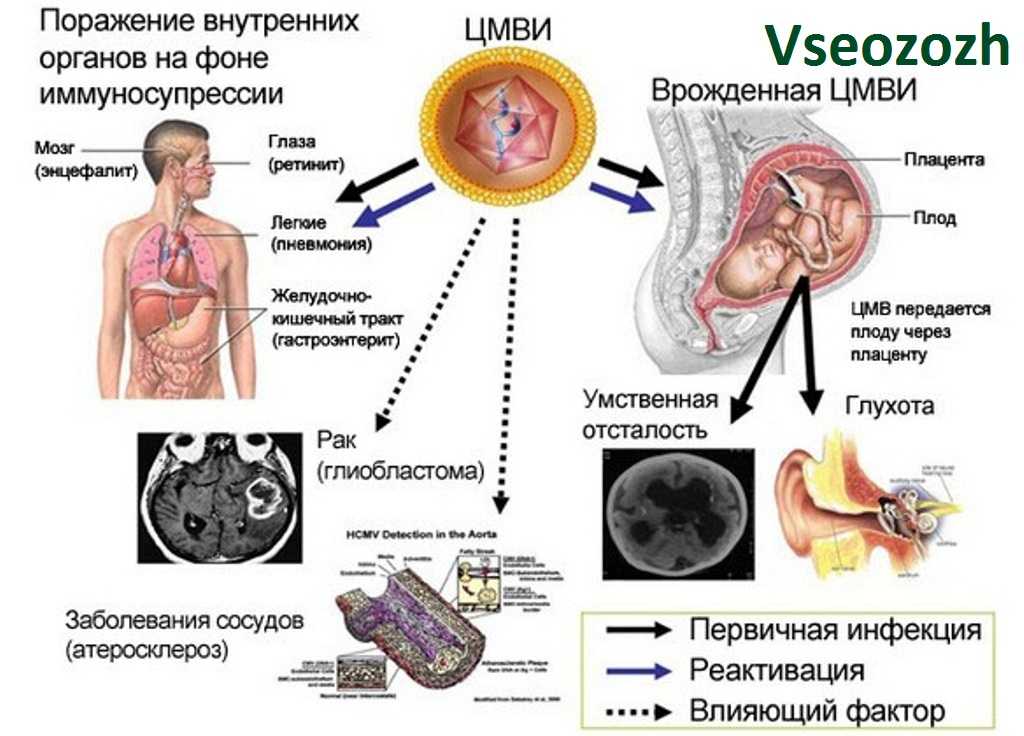 Вирус герпеса