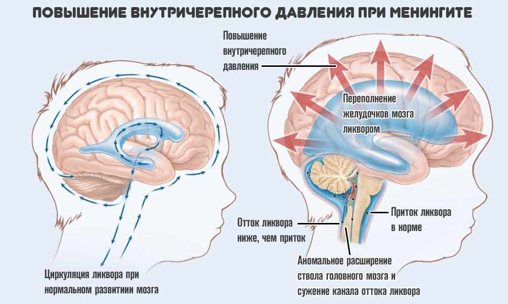 Внутричерепное давление: симптомы и лечение у взрослых, причины, как проявляется, чем опасно