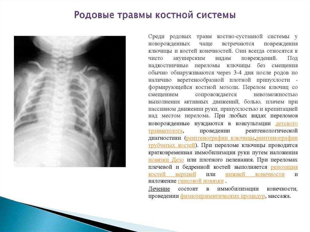 Перелом ключицы у новорожденного при родах: от симптомов до реабилитации | irksportmol.ru