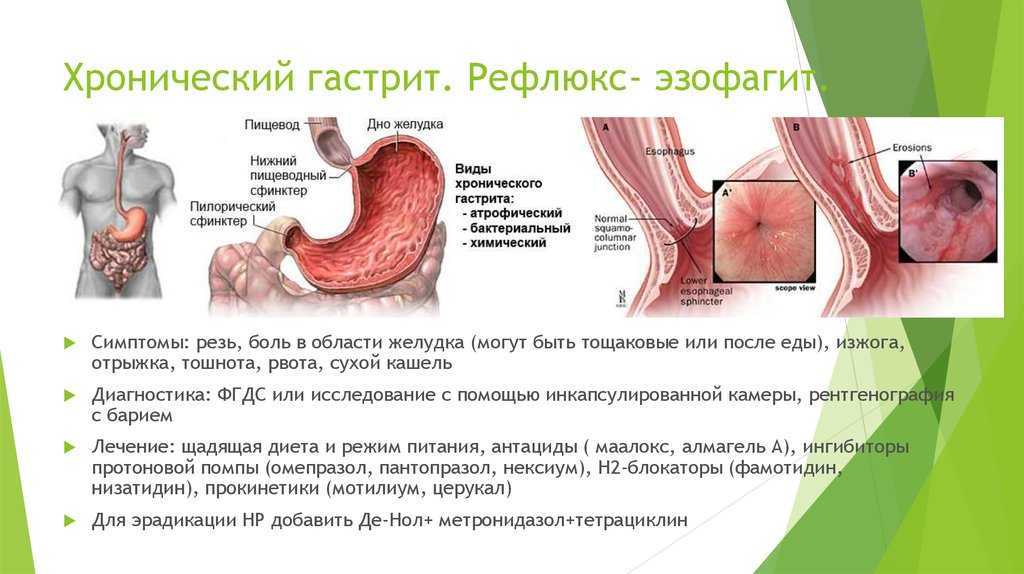 Гастрит