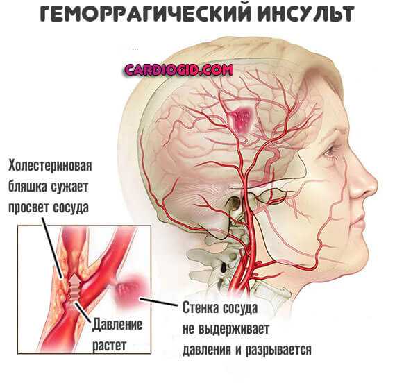 Все о геморрагическом инсульте