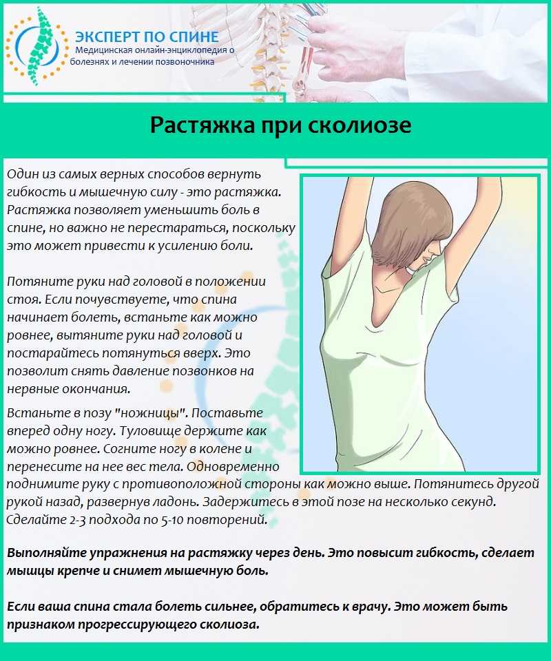 Сколиоз позвоночника: что такое, симптомы, степени и лечение