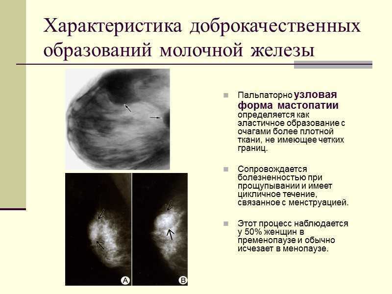 Липоматоз (множественные липомы)