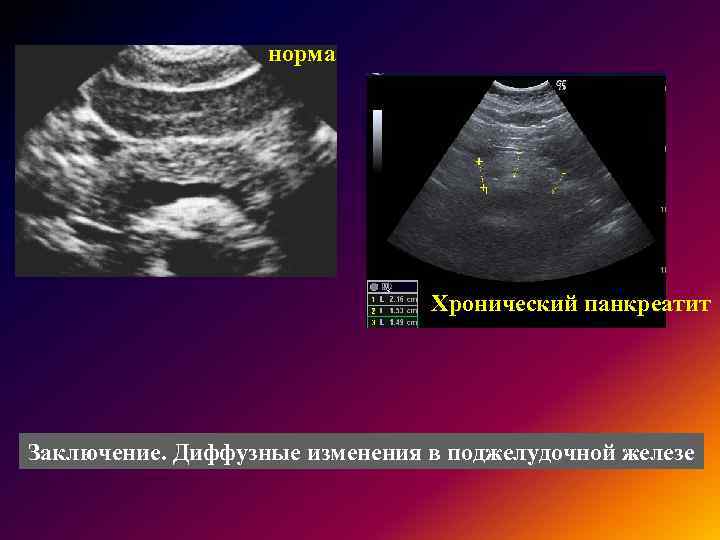 Лечение диффузных изменений поджелудочной железы, причины и первые симптомы заболевания