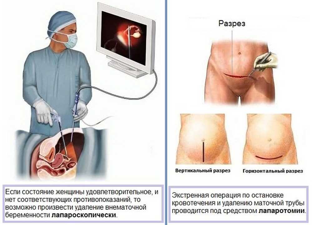 Лапаротомия матки | рак - лечение и профилактика