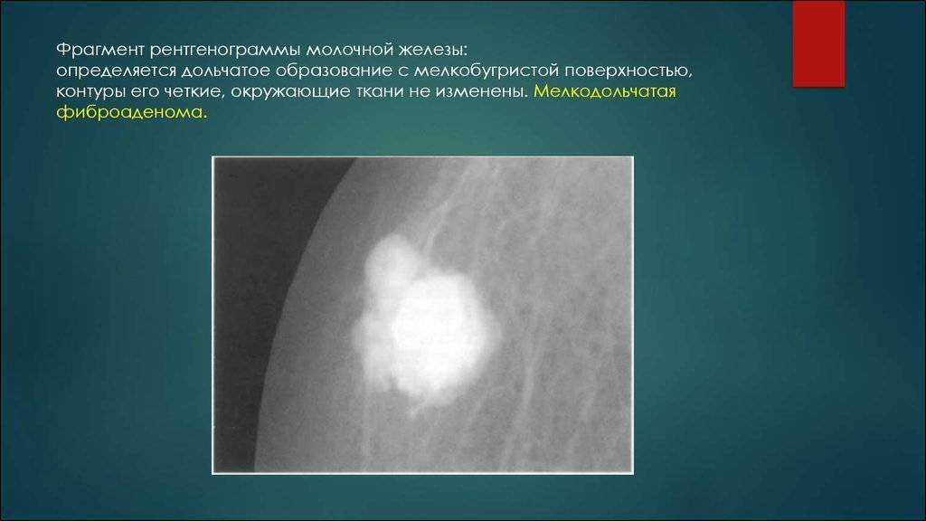 8 методов удаления липомы (жировика) - лазером, хирургически и др.