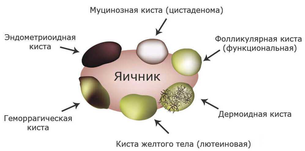 Овариальные кисты