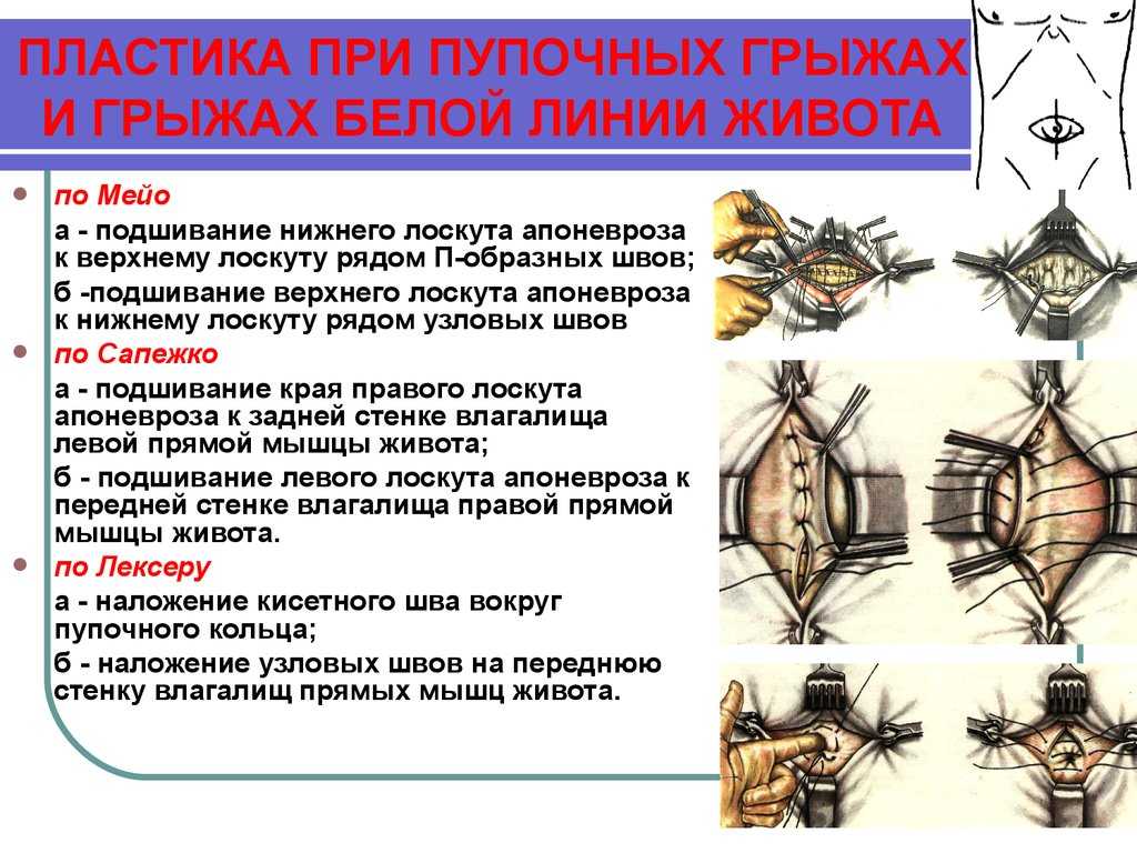 Пупочная грыжа операция