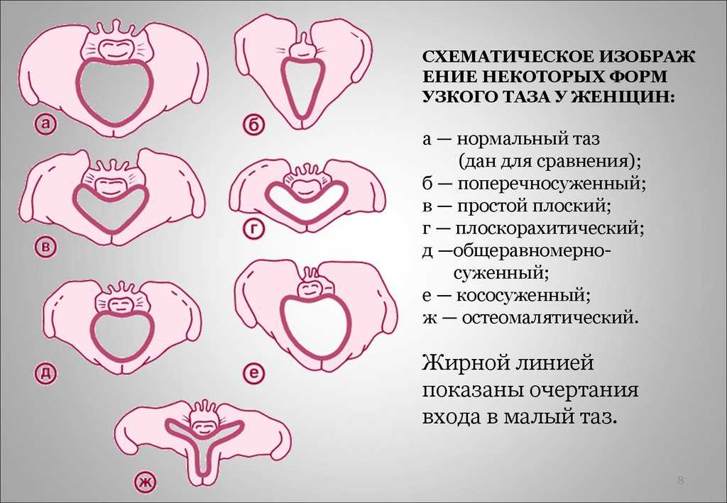Размеры таза при беременности: норма, таблица