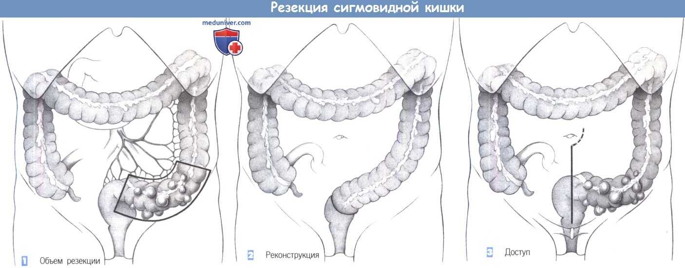 Резекция кишечника: тонкой и толстой кишки (операция удаления её части органа)