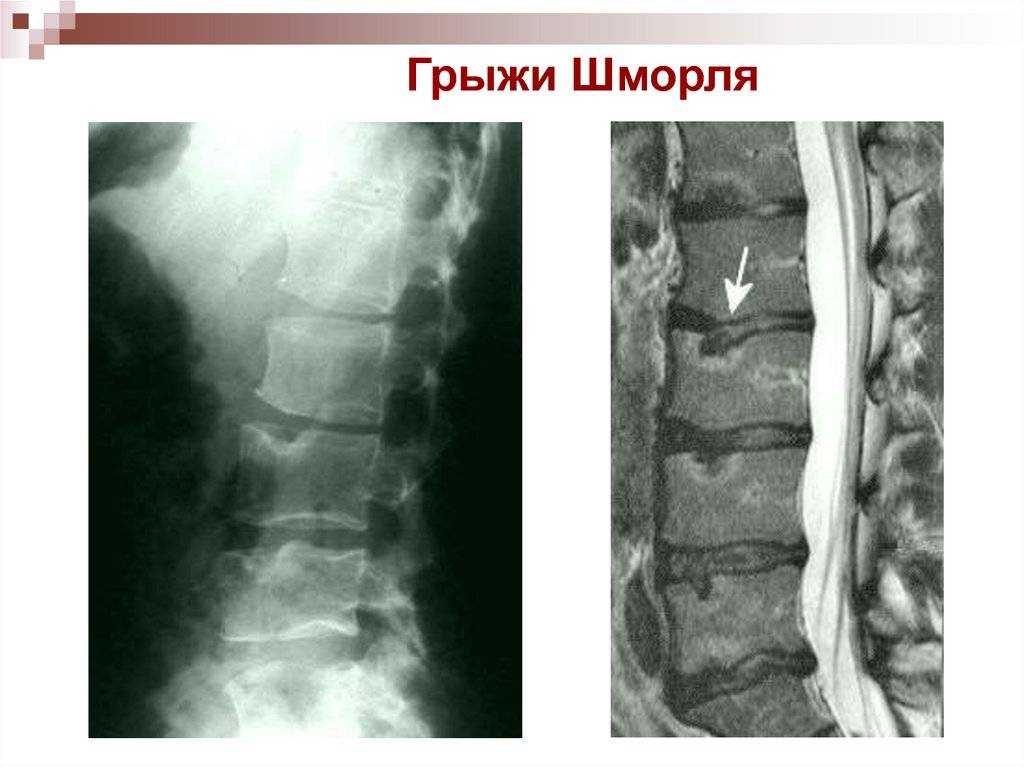 Грыжа шморля позвоночника: симптомы, лечение и фото мрт