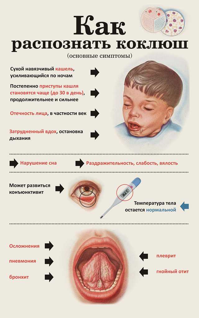 Коклюш: диагностика, симптомы, лечение – напоправку – напоправку