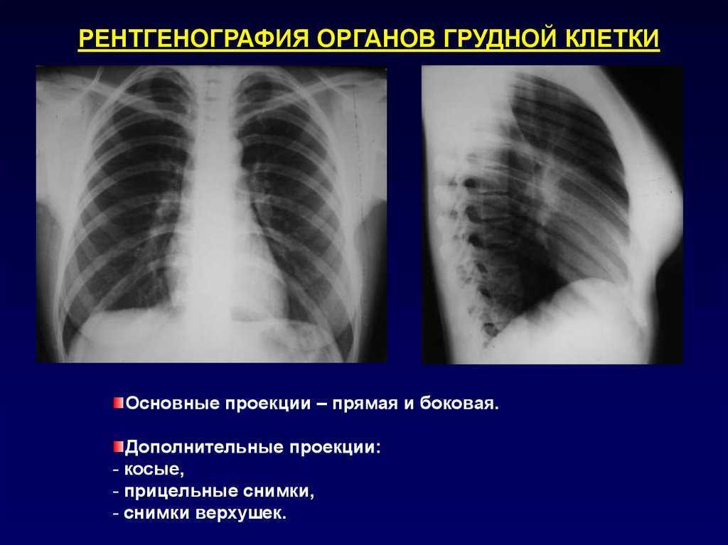 Рентген грудной клетки: что показывает, как и зачем делают, фото снимков огк