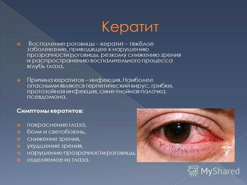 Глазные капли от конъюнктивита для взрослых и детей. показания и противопоказания.