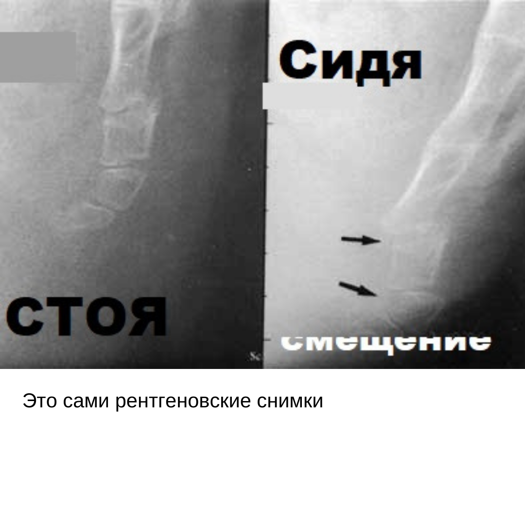 Перелом копчика: симптомы и последствия, лечение