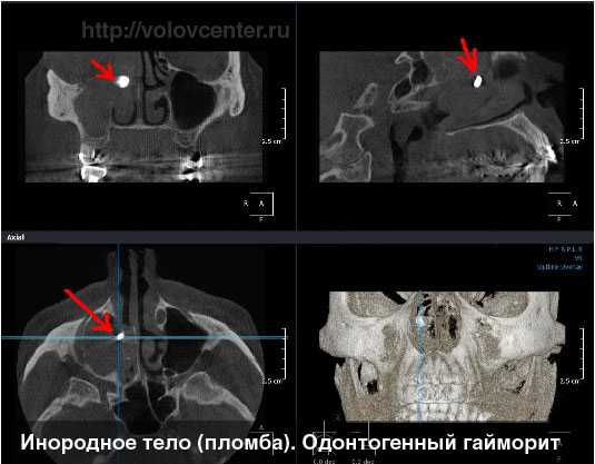 Почему развивается и чем опасна киста гайморовой пазухи  Киста гайморовой пазухи  Киста гайморовой пазухи представляет собой шаровидную емкость, заполненную