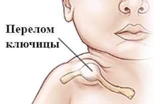Лечение перелома или вывиха ключицы у новорожденного ребенка при родах и возможные последствия