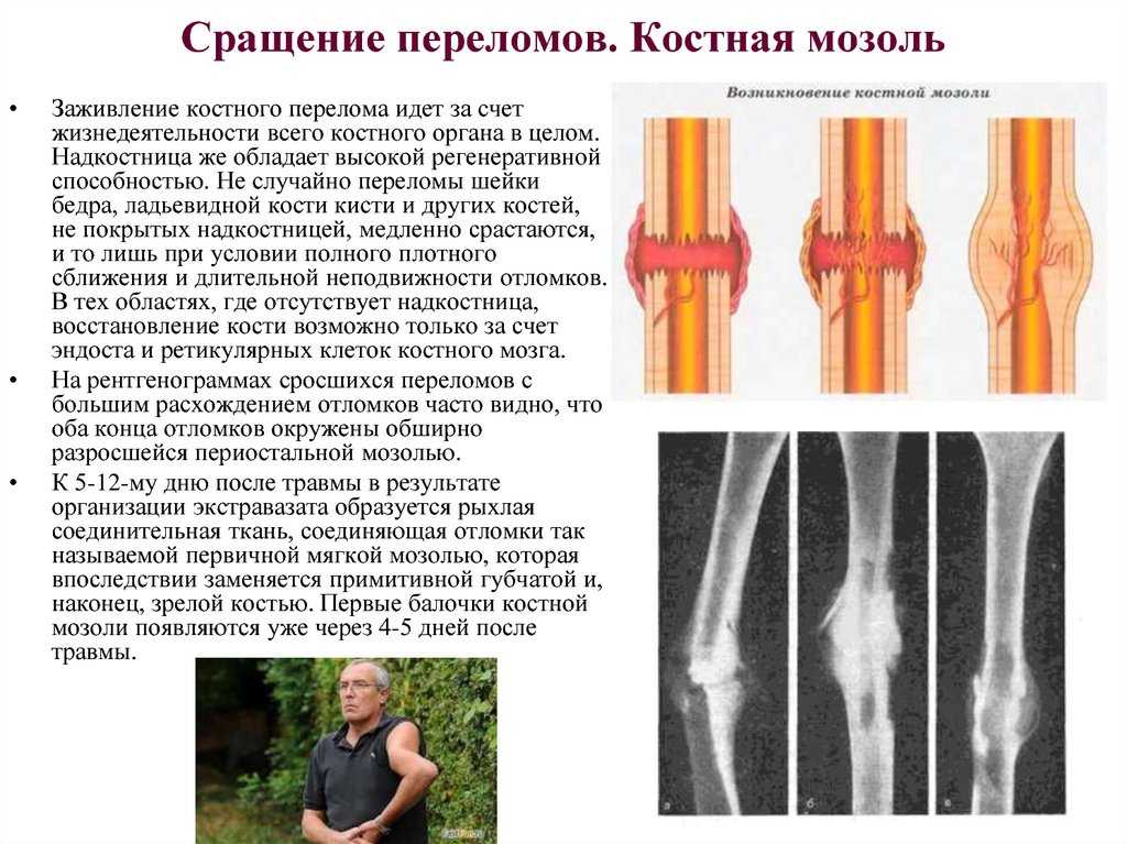 Консолидированный перелом: причины, симптомы, лечение - все о травмах и переломах