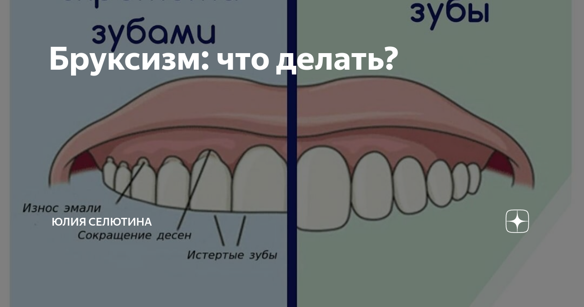 Ночной бруксизм: из-за чего взрослые начинают скрипеть зубами?