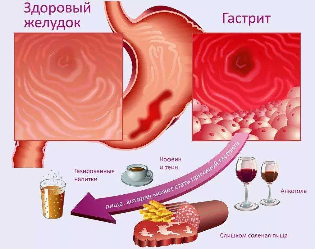 Гастрит: анализы, консультация гастроэнтеролога, диагностика, профилактика, методика лечения | услуги клиники «проксима» (г. сочи)