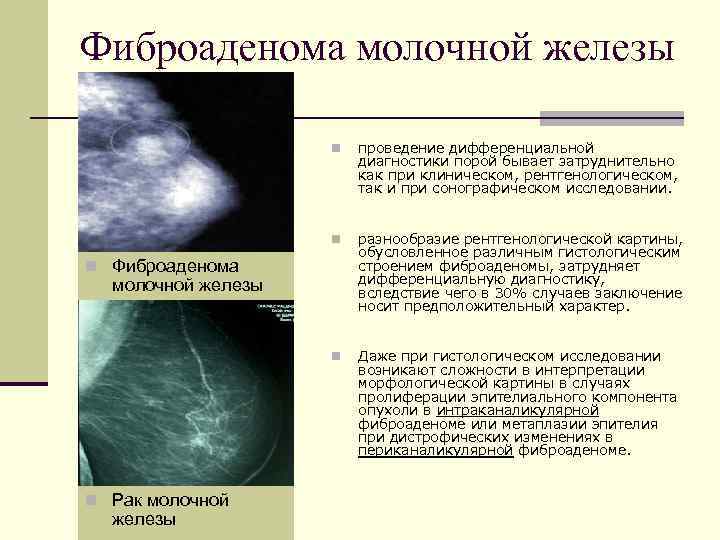 Липофиброма молочной железы: симптомы, лечение, причины развития
