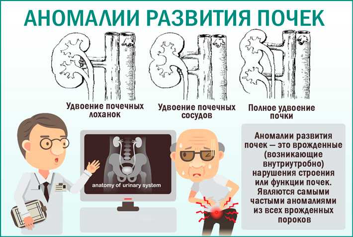 Аномалии развития почек: удвоение, отсутствие, аплазия, гипоплазия