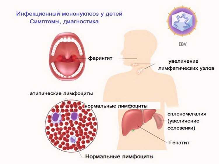 Инфекционный мононуклеоз: что это за болезнь, симптомы и причины
