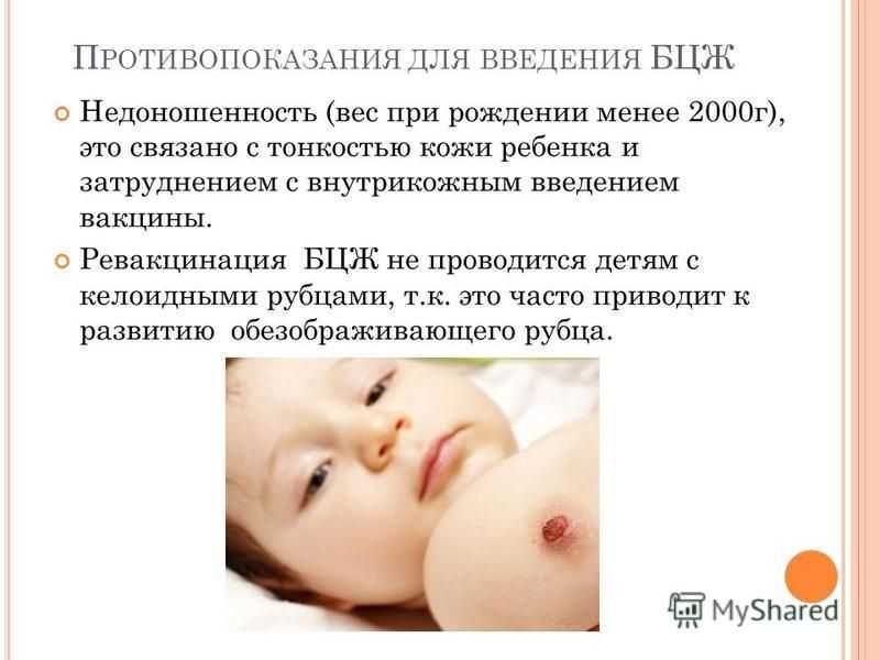 Прививка бцж новорожденным: что нужно знать маме